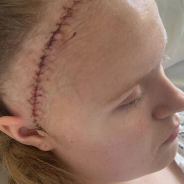 Teenager had part of skull stored in her stomach after rare brain bleed