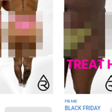 Brazilian butt lift adverts banned in the UK – here’s why
