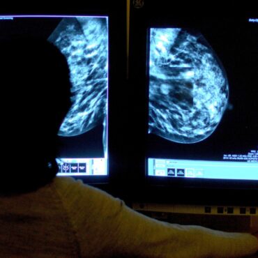 ‘Transformational’ new drug could stop breast cancer tumours before they grow, trial finds