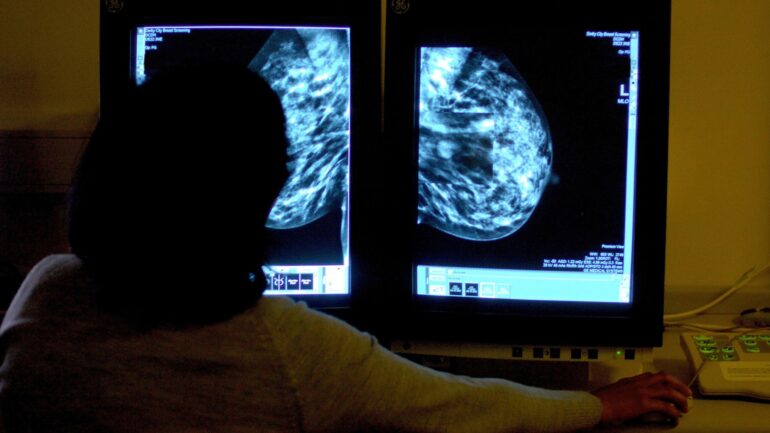 ‘Transformational’ new drug could stop breast cancer tumours before they grow, trial finds