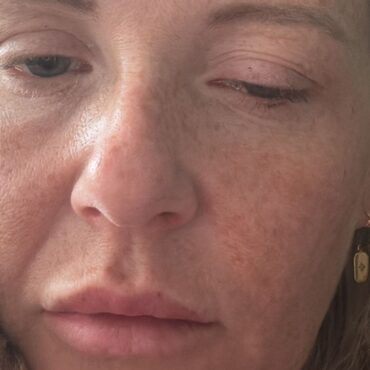 ‘It’s the Wild West’: Dozens of women develop botulism linked to anti-wrinkle injections