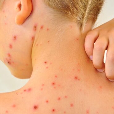 Chickenpox vaccine to be offered on NHS next year