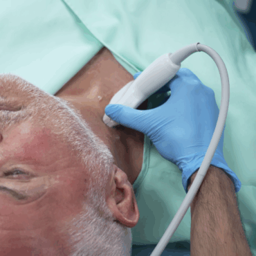 Neck scan could detect risk of heart attack and stroke
