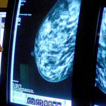 AI mammograms result in fewer aggressive breast cancers, study suggests