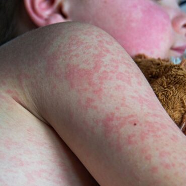 UK loses measles elimination status, warns WHO