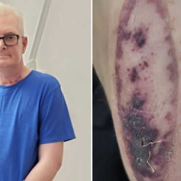 Organ donor’s skin patch helped patient discover new lung was being rejected