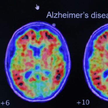 Simple at-home test can predict Alzheimer’s risk, says study