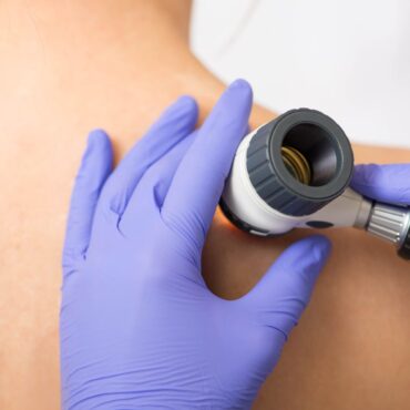 Skin cancer cases at record high in UK