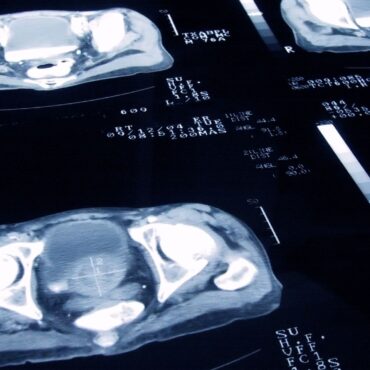 ‘Missed opportunity’ as government rejects call for mass prostate cancer screening