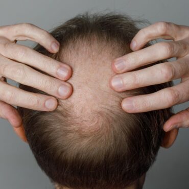 Weight loss drugs linked to increased risk of hair loss