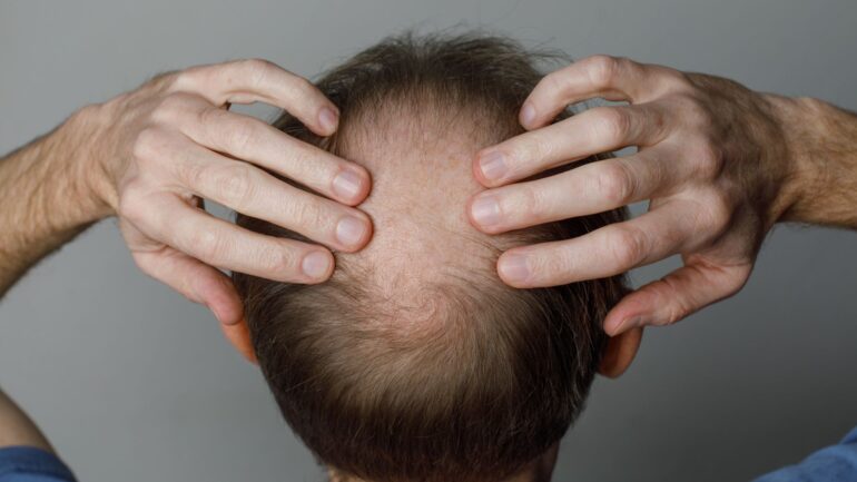 Weight loss drugs linked to increased risk of hair loss