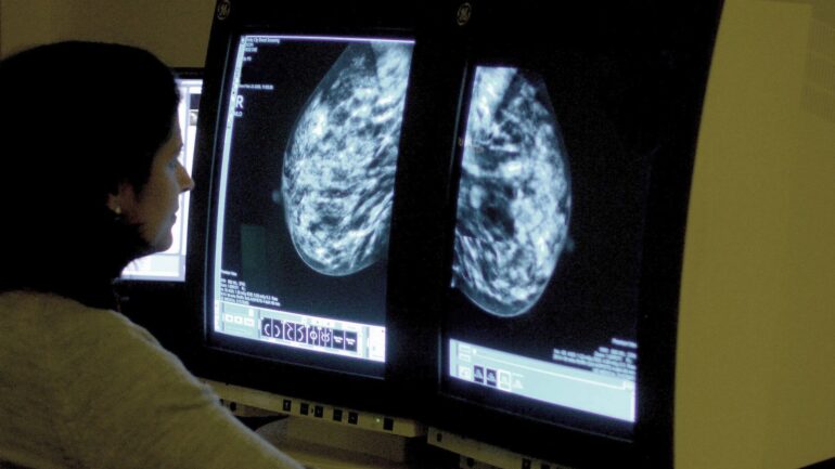 Women under 50 at risk of breast cancer are not being referred – study