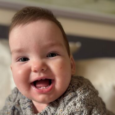 Baby boy given world-first treatment for rare skull condition