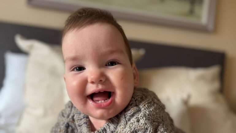 Baby boy given world-first treatment for rare skull condition