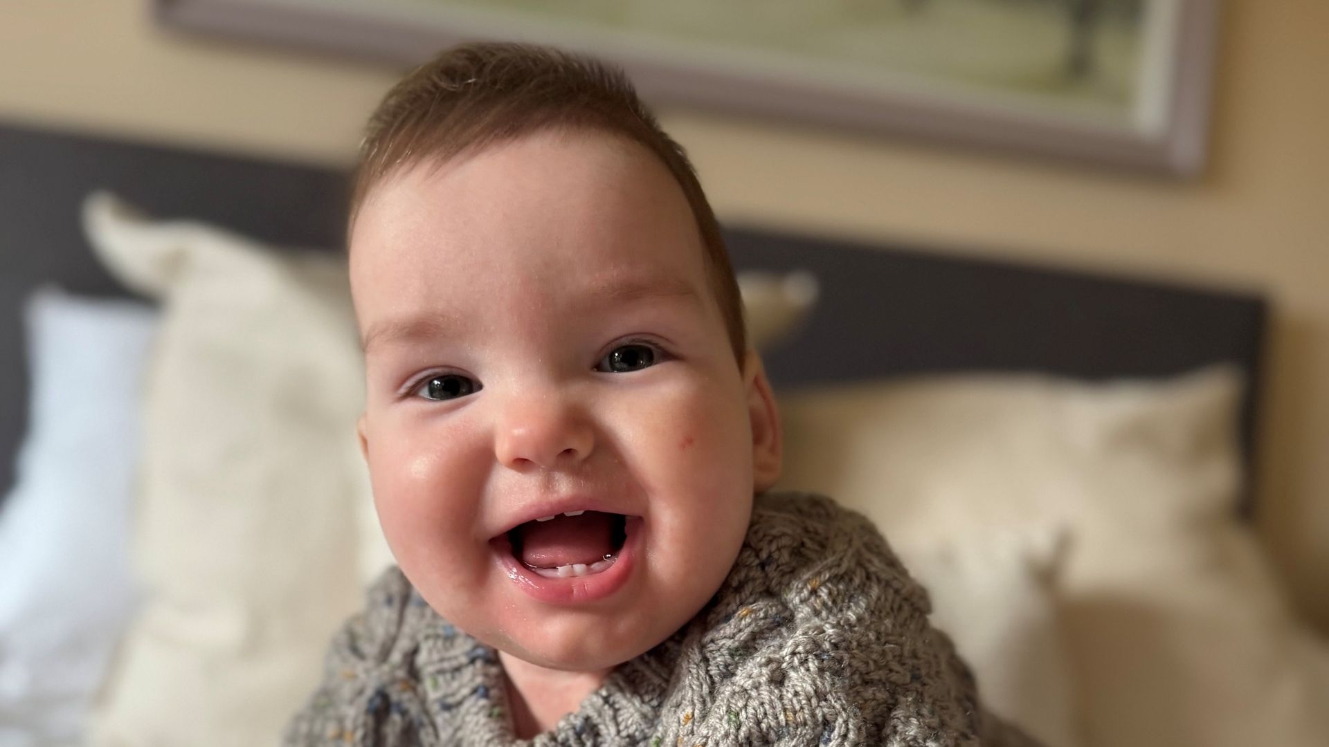 Baby boy given world-first treatment for rare skull condition